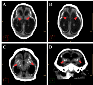 Most frequent characteristics described. Axial (A, B and C) and coronal (D) non-contrast brain CT. A and B show a 1 month old infant female evidencing severe microcephaly with subcortical gross calcifications (red arrowheads), accentuated compensatory lateral ventricles dilation and loss of typical sulcation configuring lisencephaly. (C and D) Gross calcifications in the basal ganglia (red arrows) in a 2 months old female newborn, configuring one of the most typical findings of this presentation.