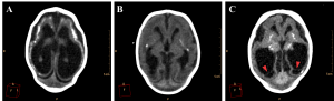 Axial non-contrast brain CT with three different patterns of parenchymal atrophy and compensatory ventricular dilation. Ventricular adherences are suggested by the presence of thin septations with soft tissue density observed in the occipital horns of lateral ventricle (red arrowheads in C).