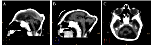Sagittal (A and B) and axial (C) non-contrast brain CT showing cerebellar atrophy/hypoplasia.