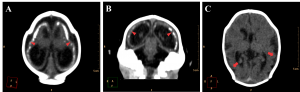 Neuronal migration disorders in female newborns in axial (A and C) and coronal (B) images, showing a pattern of lissencephaly/agyria (red arrowheads) and pachygyria (red arrows).