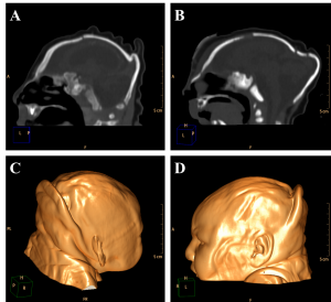 Sagittal section evidences cranial bones overlap (A), frontal and occipital bones horizontalization (B), which could be observed clinically in association to cutaneous folds accentuation (Volume Rendering; C e D).