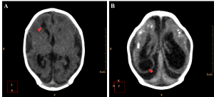 Cystic encephalomalacia in the periventricular white matter (red arrowheads) of the right lateral ventricle frontal horn (A) and adjacent to its occipital horn (B).