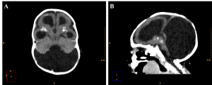 Axial (A) and sagittal (B) non-contrast brain CT show a 3 month old infant female evidencing hypoplastic cerebellar vermis, cystic dilatation of the fourth ventricle and enlargement of the posterior fossa, representing Dandy-Walker syndrome.